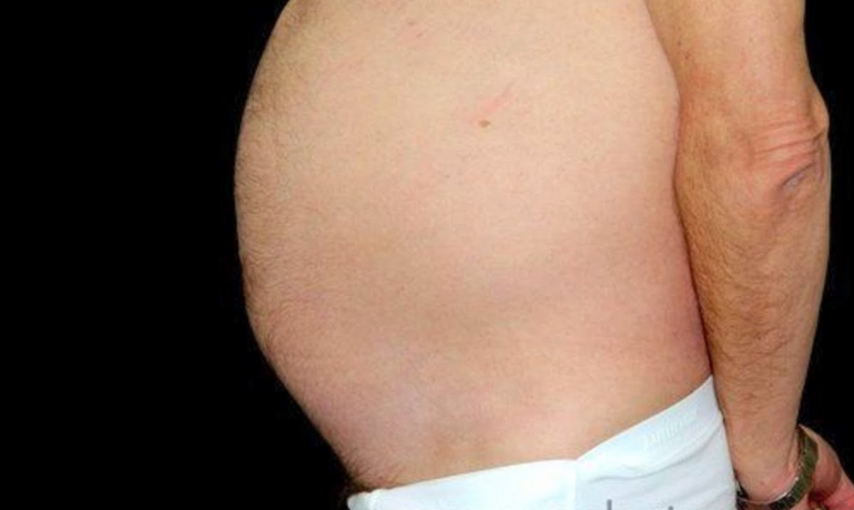 Punción evacuadora de líquido de Ascitis